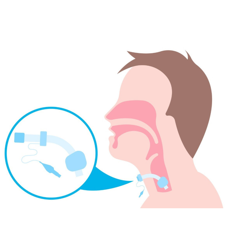 Rurka do Tracheostomii Silikonowa Provox LaryTube Bez Fenestracji 10