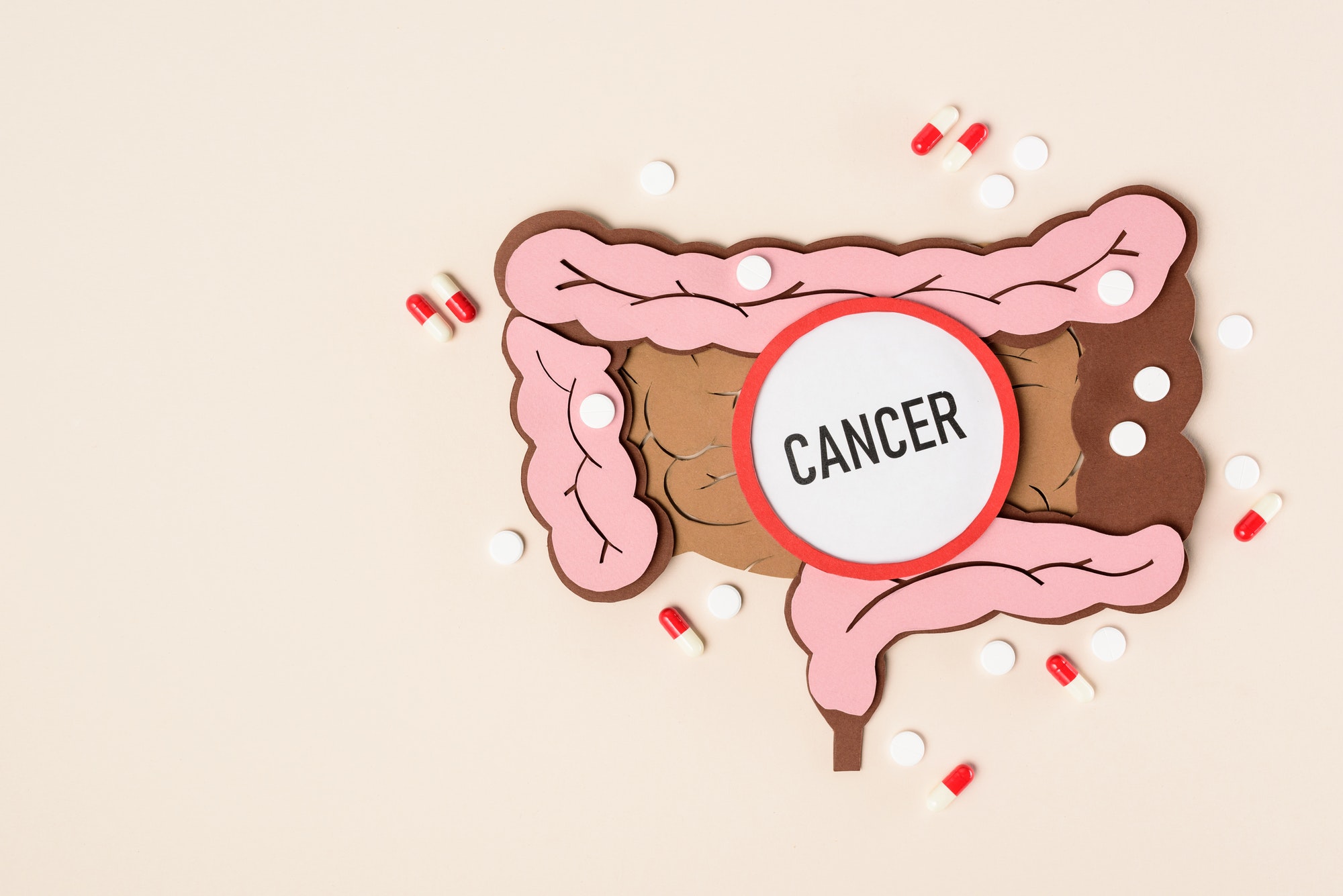 Rak jelita grubego – przyczyny, najczęstsze objawy i metody leczenia
