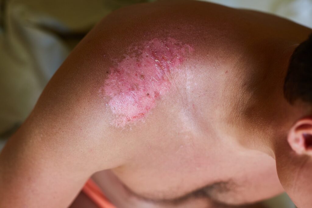 Severe sunburn on the man's shoulder. Ulcers and reddened, itchy skin after sunburn.